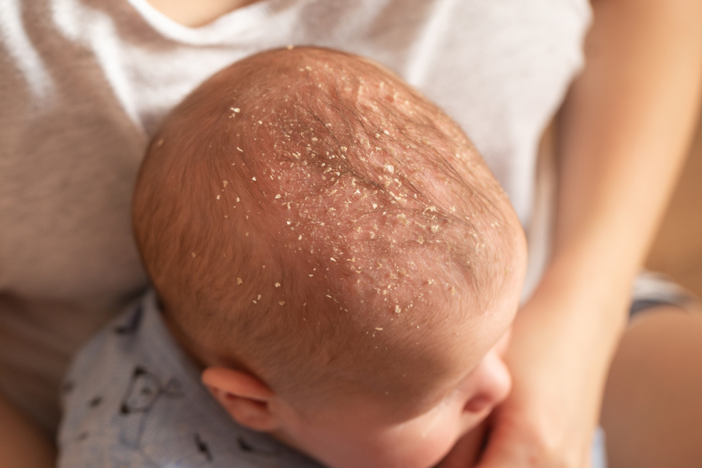 Cradle cap produces yellow scales on the scalp. Photo: Shutterstock