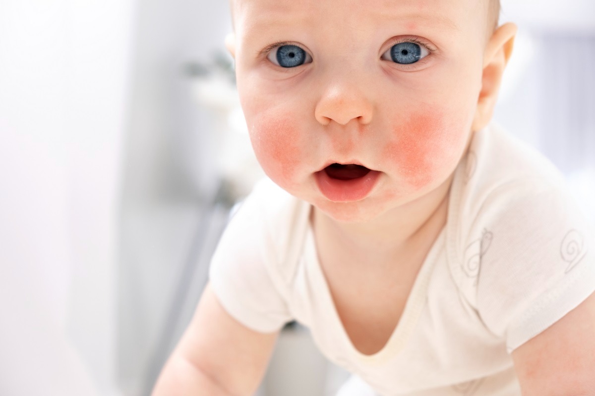 La quinta enfermedad. ¿Sabes qué es y cómo podría afectar a tu bebé?
