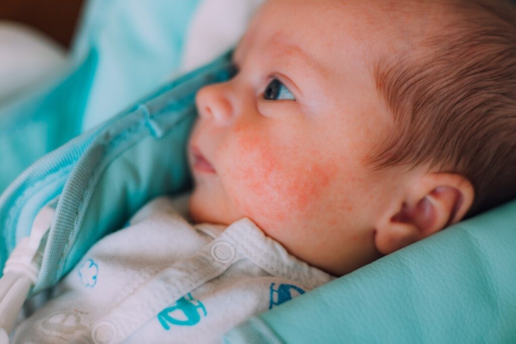 La quinta enfermedad. ¿Sabes qué es y cómo podría afectar a tu bebé?